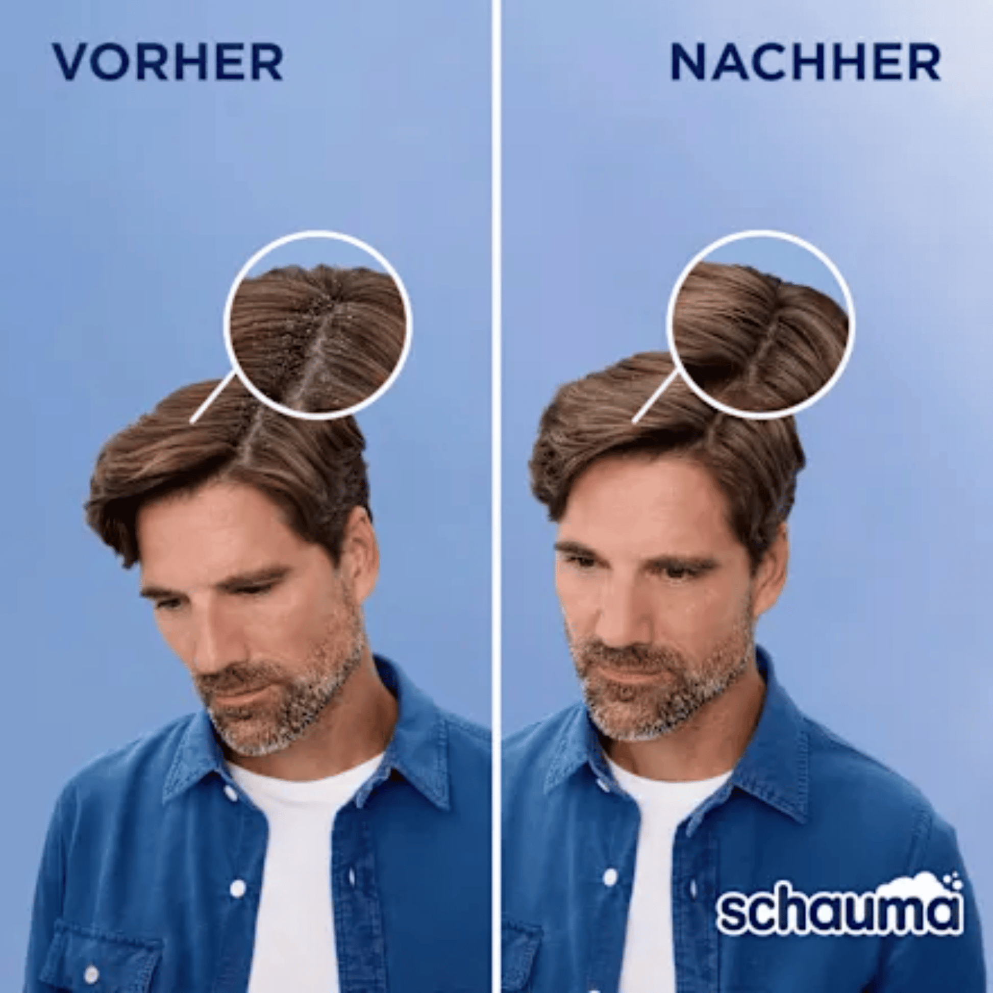 Alternate Image of Anti-Dandruff Classic Shampoo, before and after model